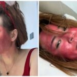 22 Tahun Tak Bersihkan Makeup, Perempuan Ini Derita Ruam Parah di Wajah